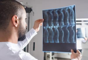 Radiologist looking at spinal cord injury x-ray