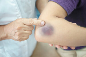 A patient with a contusion on the elbow